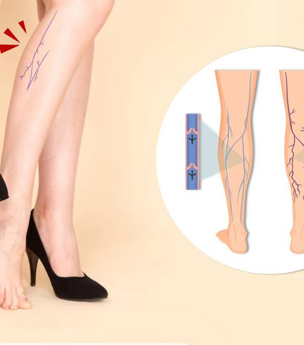 小腿腫脹痠痛癢－靜脈曲張的治療與保養