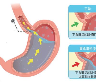 胃食道逆流-