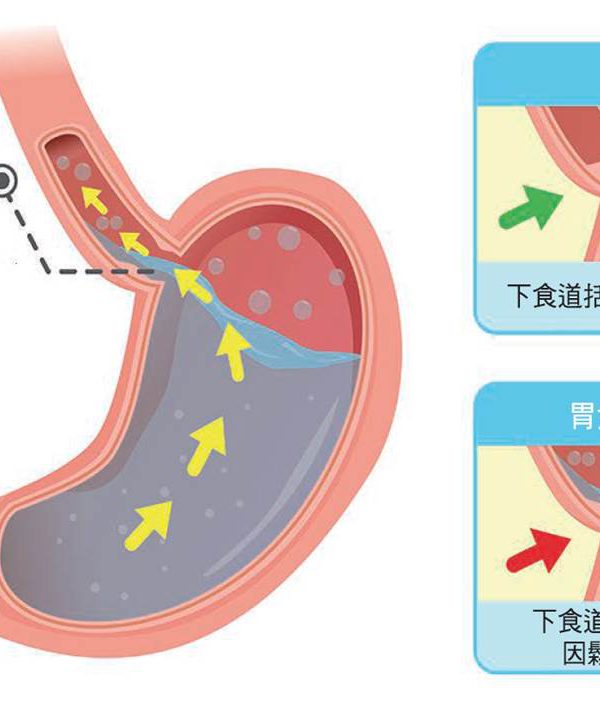 胃食道逆流的治療與防治