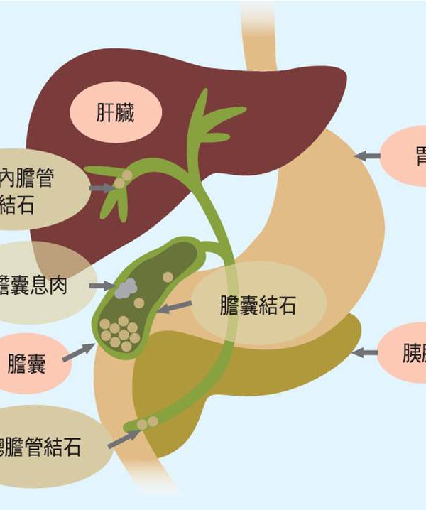 膽結石及腹腔鏡膽囊切除術