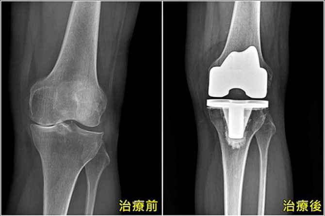 《健康聚寶盆》75歲嬤膝蓋痛 雙腿磨成Ｏ型腿