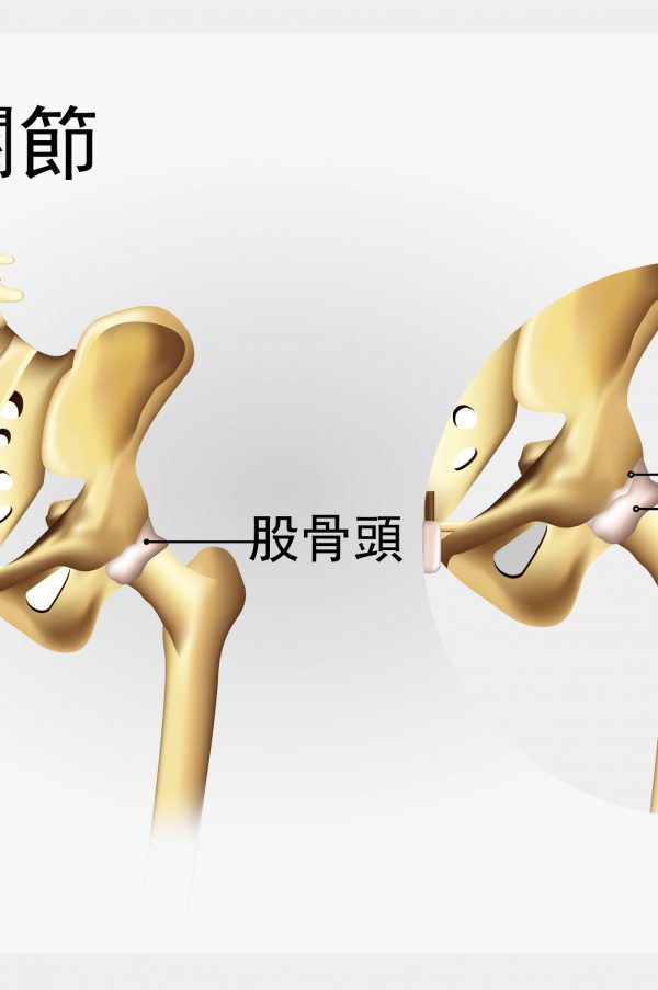 髖關節的手術治療