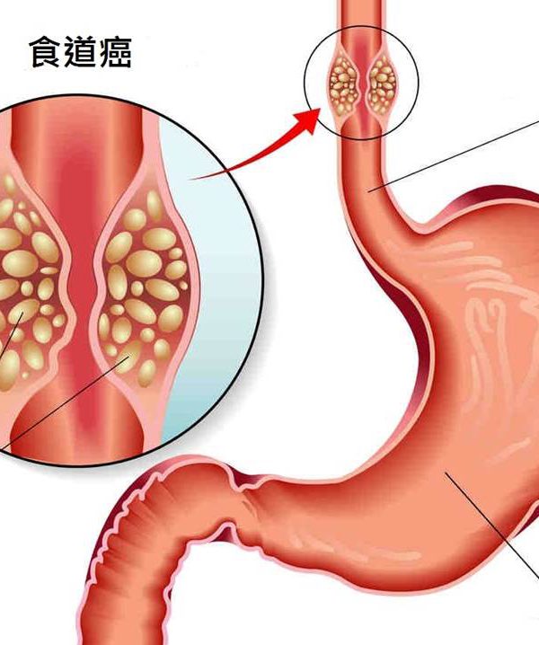 為何食道癌會快速奪命