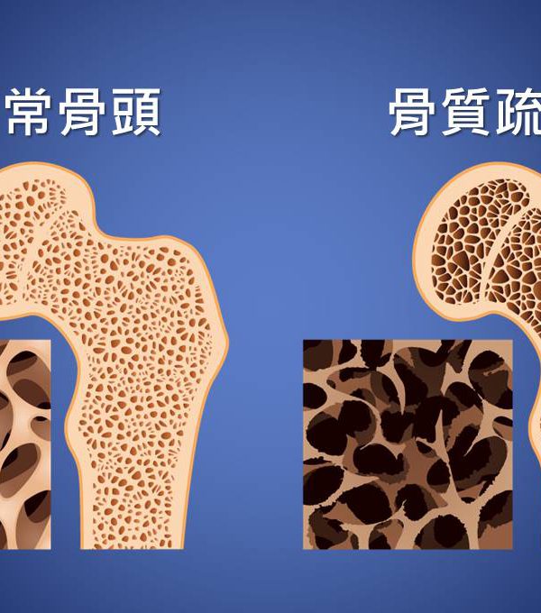 骨鬆須注意 治療有方法