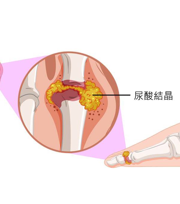 下肢關節紅腫熱痛的帝王病－痛風