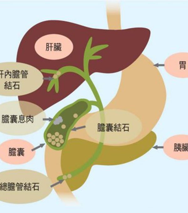 膽囊常見的疾病：膽結石及膽息肉