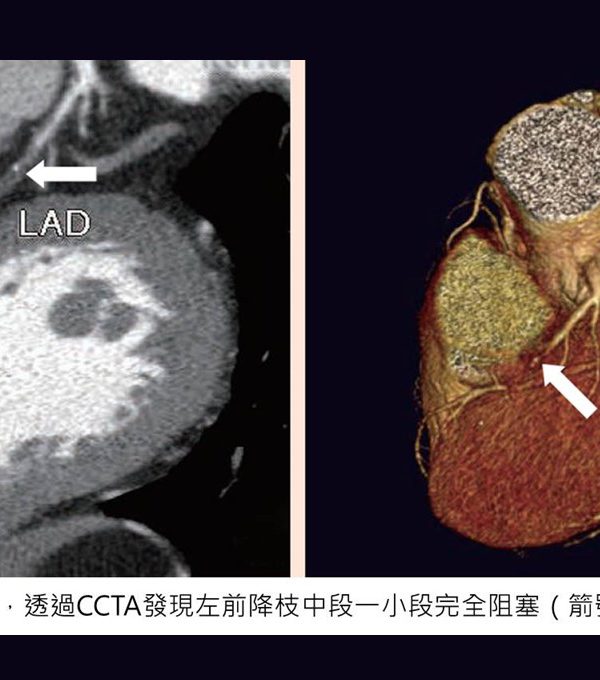 偵測冠心病的篩檢利器─冠狀動脈電腦斷層血管攝影