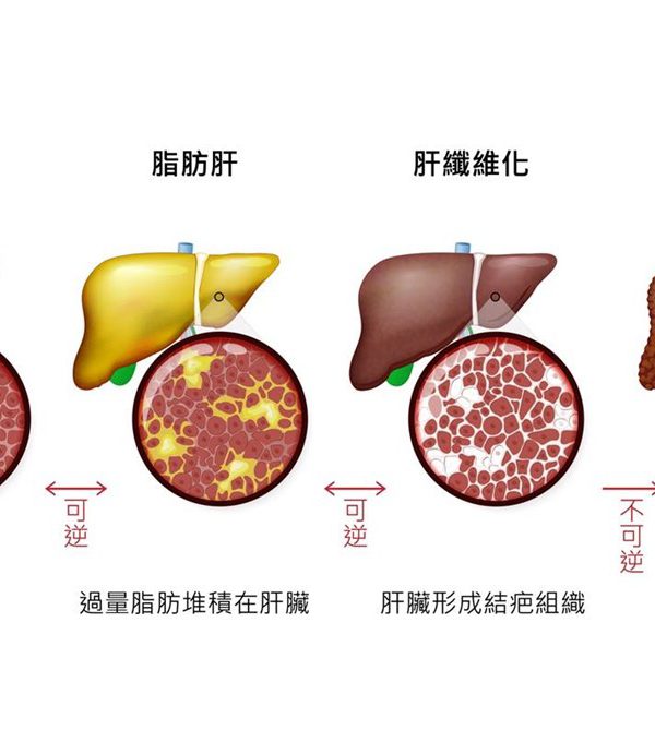 認識脂肪肝 非酒精性脂肪肝病的健康危機