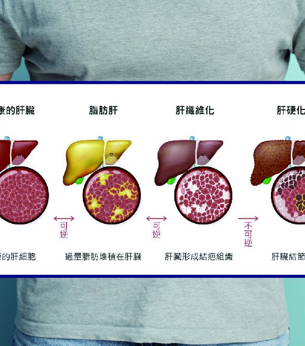 代謝相關脂肪肝病的健康危機